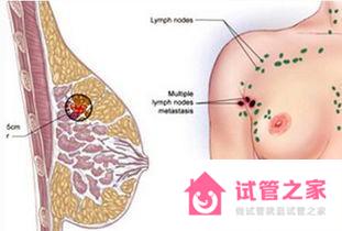 乳腺癌能做第三*試管嬰兒篩掉嗎