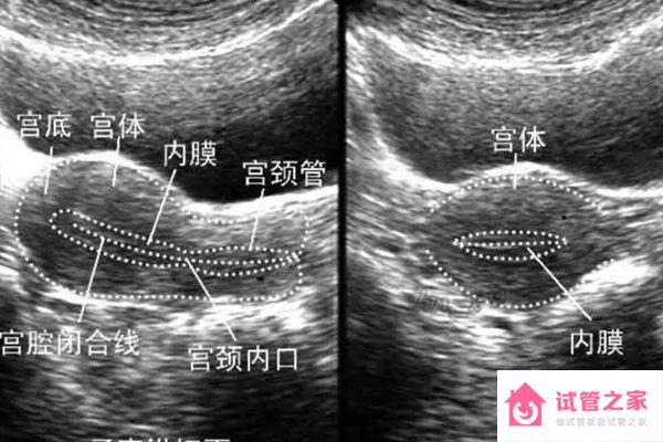 子宮內(nèi)膜薄可做宮腔理療