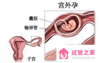 宮外孕征兆有哪些