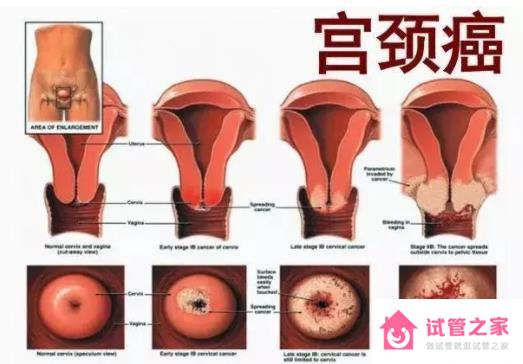 宮頸癌是什么原因?qū)е碌? width=