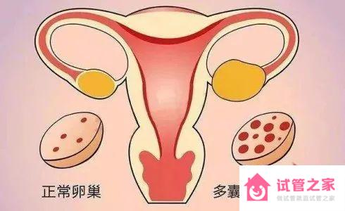 促黃體生成素多少以上算多囊