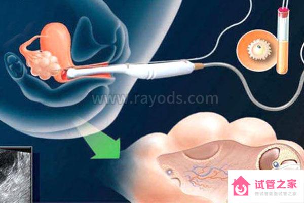 廣州做三*試管嬰兒過(guò)程痛苦嗎