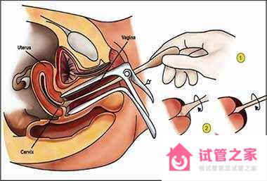 宮頸抹片是什么檢查