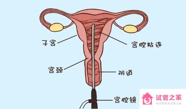 宮腔粘連做試管需要先檢查