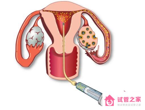 人工助孕多少錢，花費明細表