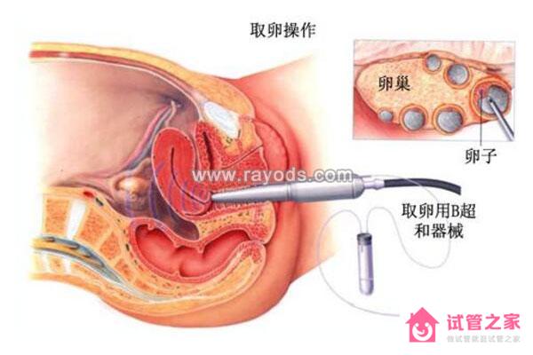 泰國(guó)試管嬰兒周期安全性高，主要體現(xiàn)在以下三個(gè)方面