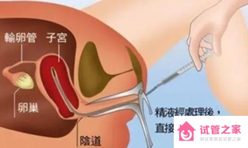 人工授精精子怎么弄進去的