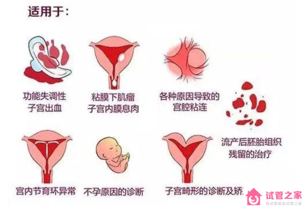 做試管嬰兒前要做宮腔鏡檢查嗎?