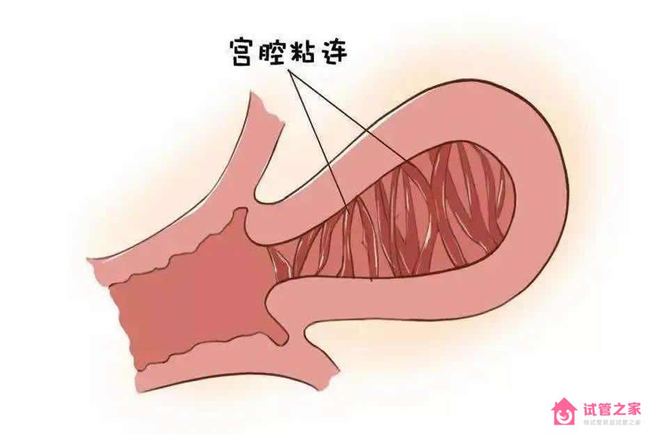 宮腔有輕微粘連會影響試管嬰兒成功率嗎？需結(jié)合自身實際情況考量 ...