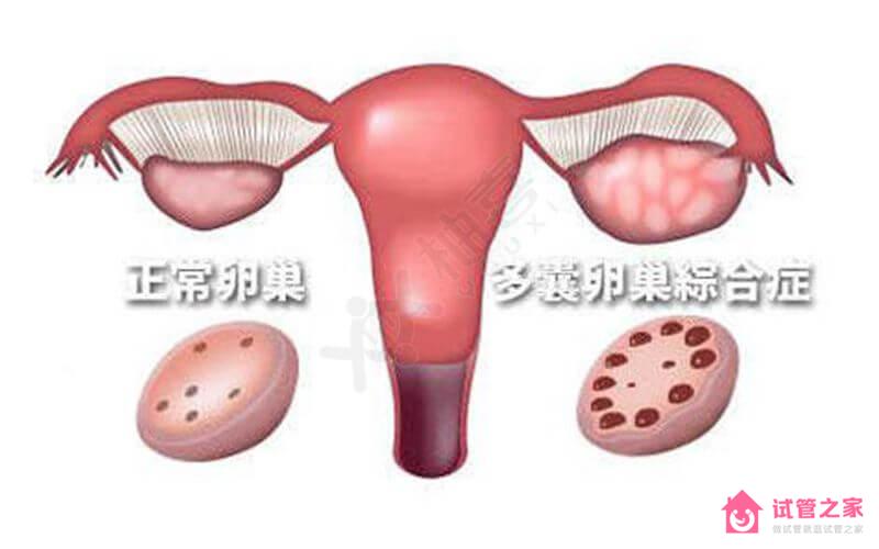 好“孕”妙招!多囊*巢備孕這4種情況下要做試管嬰兒