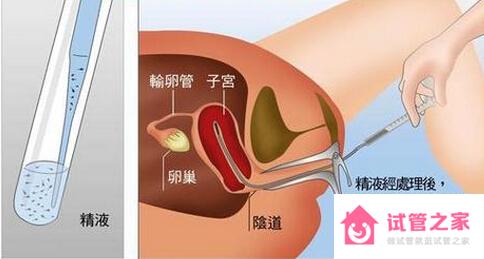 人工授精是什么意思