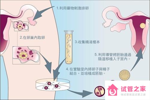 什么是試管嬰兒,試管嬰兒流程怎么做的？