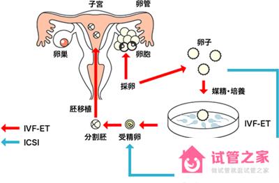 什么情況下非得做試管嬰兒？有哪些流程步驟？