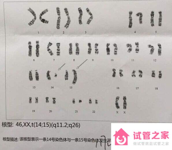 染色體平衡異位，2次胎停，做泰國(guó)試管嬰兒一次順利好孕！