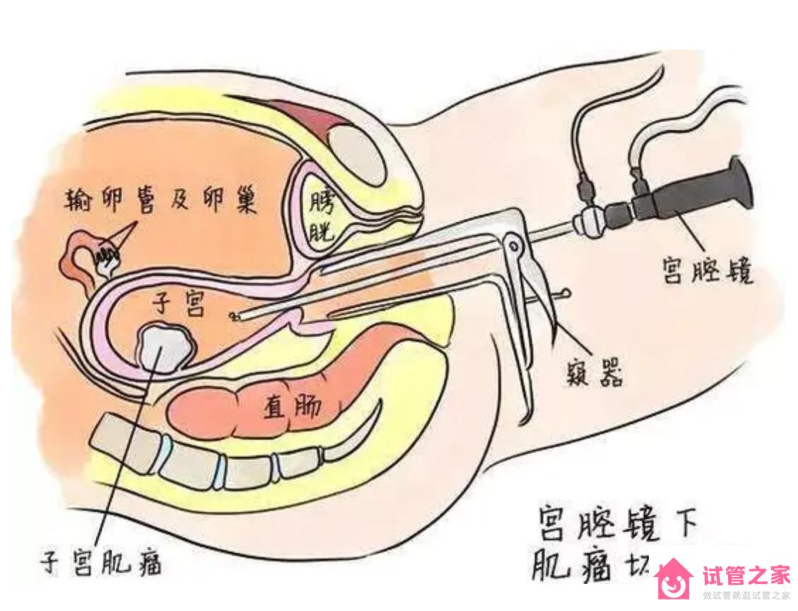 泰國試管嬰兒胚胎移植前需要做宮腔鏡嗎？