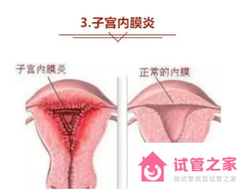 慢性子宮內(nèi)膜炎可以做試管嗎