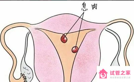 子宮內(nèi)膜息肉拖久了會怎么樣 子宮內(nèi)膜息肉可以分為兩種