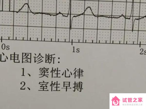 頻發(fā)室性房室早搏影響做人工授精不？