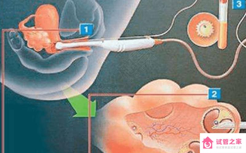 盆腔粘連做試管得看情況！可能會(huì)影響取*和移植