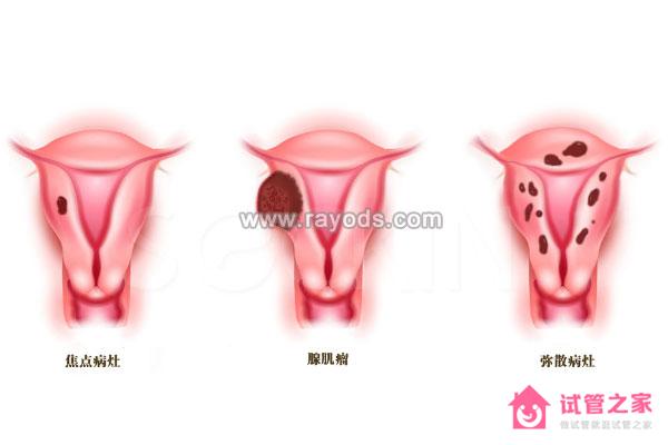 分析子宮腺肌癥去泰國(guó)做試管嬰兒的可行性及成功率