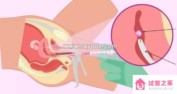 分析子宮腺肌癥去泰國(guó)做試管嬰兒的可行性及成功率