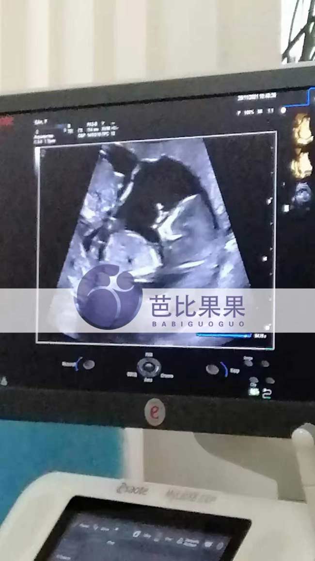 w女士家的烏克蘭照B超腹內(nèi)倆個胎寶寶發(fā)育情況良好