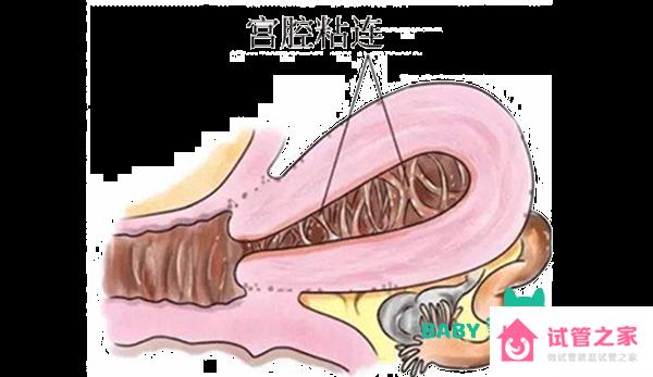 b超能診斷出宮腔粘連嗎？宮腔粘連的診斷方法一覽