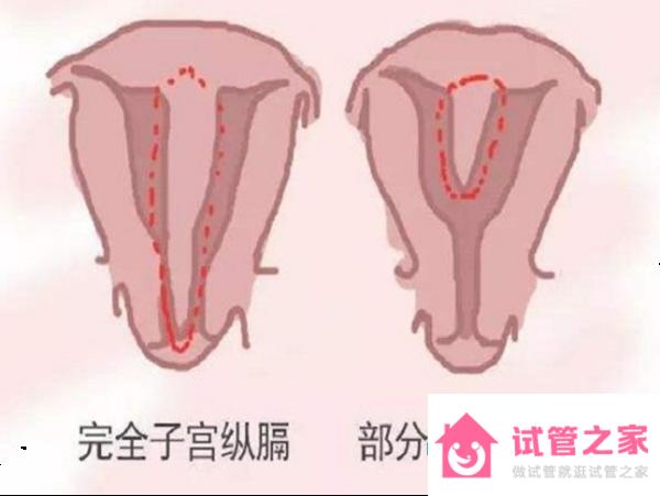 26歲女性縱隔子宮能懷孕嗎？