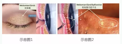 麥粒腫（針眼）：小眼疾，大隱患，王越醫(yī)生教你如何防治