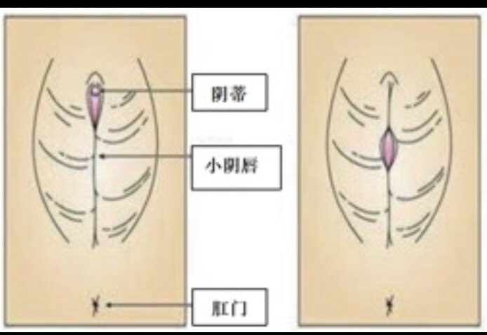 什么是小陰唇黏連？需要處理嗎？該如何避免？