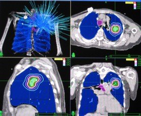 肺癌的放療