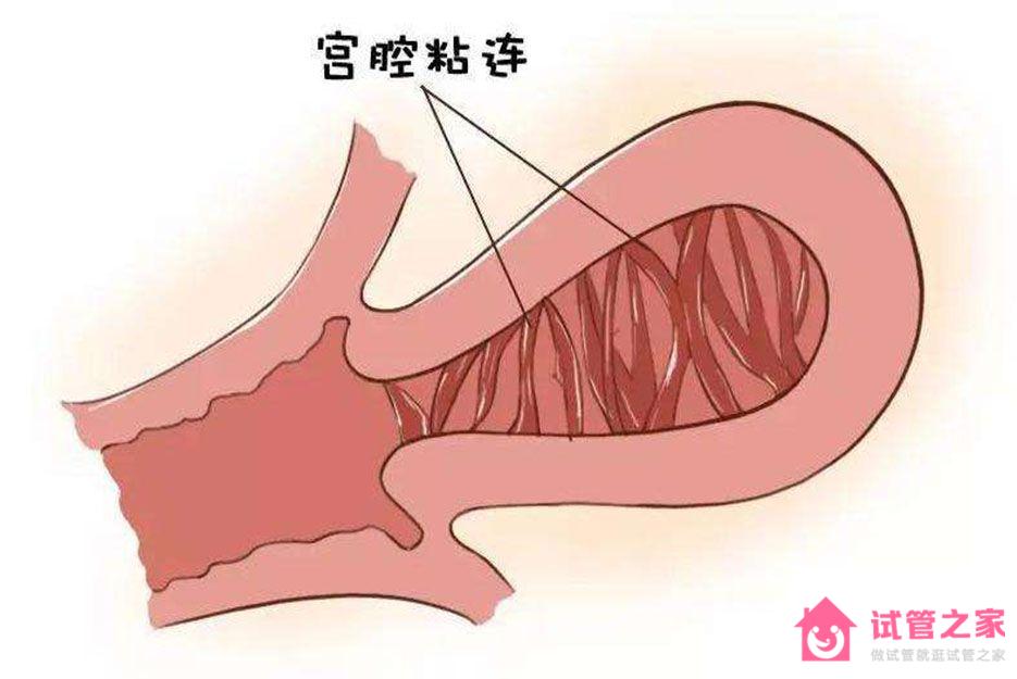 廣州宮腔粘連手術(shù)哪家醫(yī)院好？看完你心中就有數(shù)了