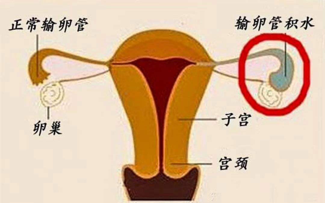 輸*管積水不處理會(huì)影響試管嬰兒移植后的胚胎著床嗎？