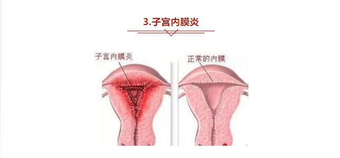 慢性子宮內(nèi)膜炎與女性不孕