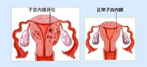 子宮內(nèi)膜異位如何緩解？