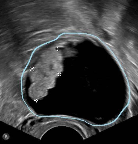 B超如果這么描述，*巢囊腫就可能是惡性的！