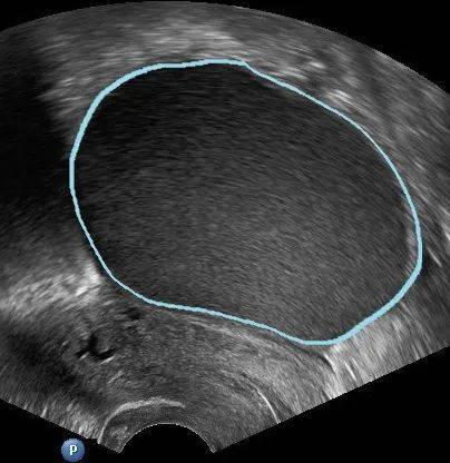 B超如果這么描述，*巢囊腫就可能是惡性的！