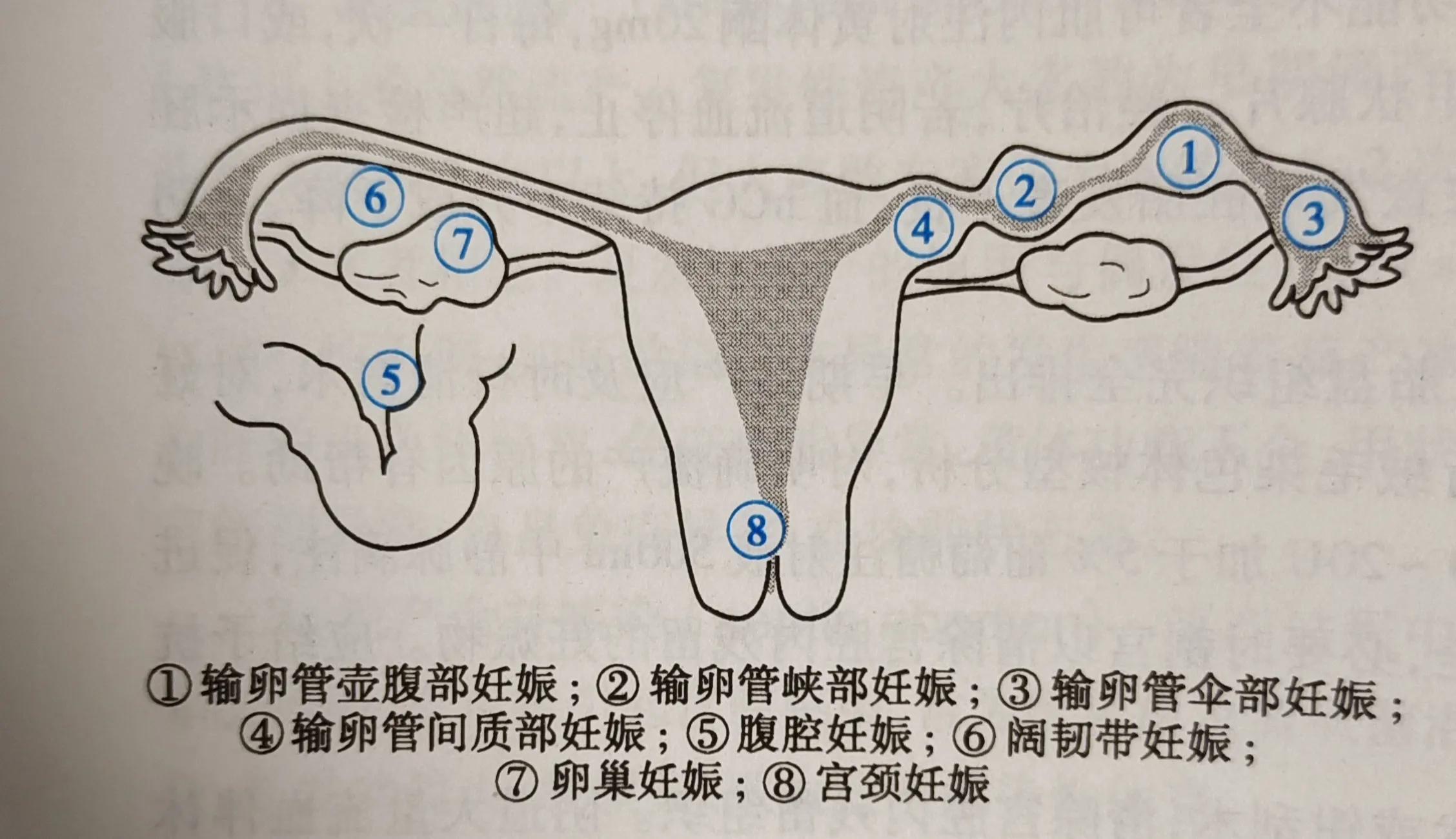 什么樣的&ldquo;宮外孕&rdquo;適合保守治療？