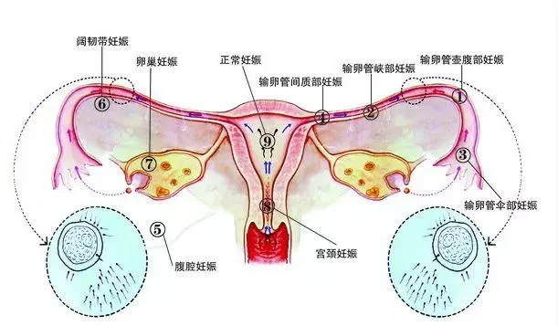 什么是雙側(cè)輸*管妊娠？