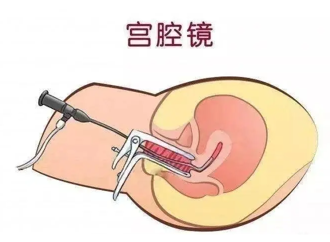 為什么要做腹腔鏡和宮腔鏡檢查？