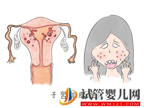 子宮內(nèi)膜異位癥——痛經(jīng)的一種常見病因