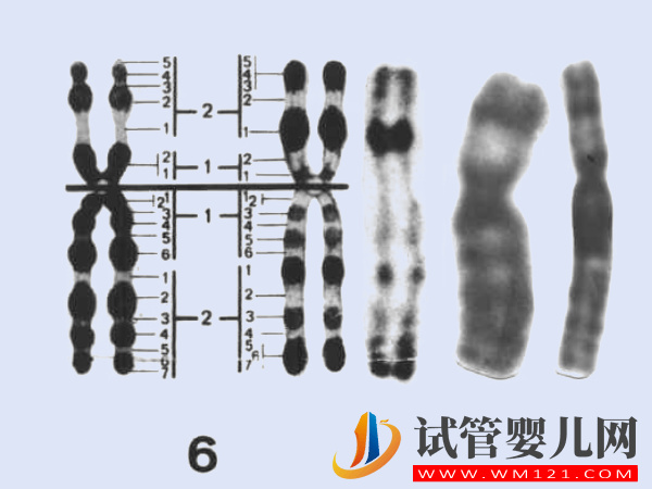 6號染色體缺失、重復相關疾病匯總，不同異常對寶寶影響不一 ...