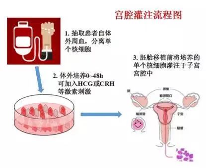 試管嬰兒知識科普：試管嬰兒反復移植失敗的助力“神器”！宮腔灌注技術 ...