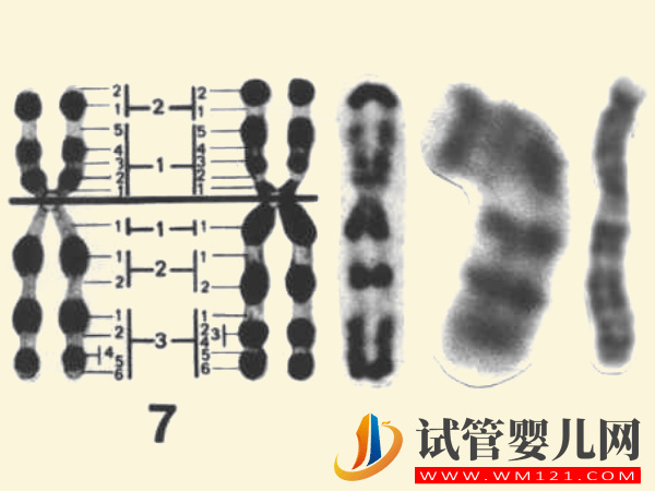 7號(hào)染色體異常真不是騙局，出現(xiàn)三體、偏多孩子會(huì)有這些疾病 ...