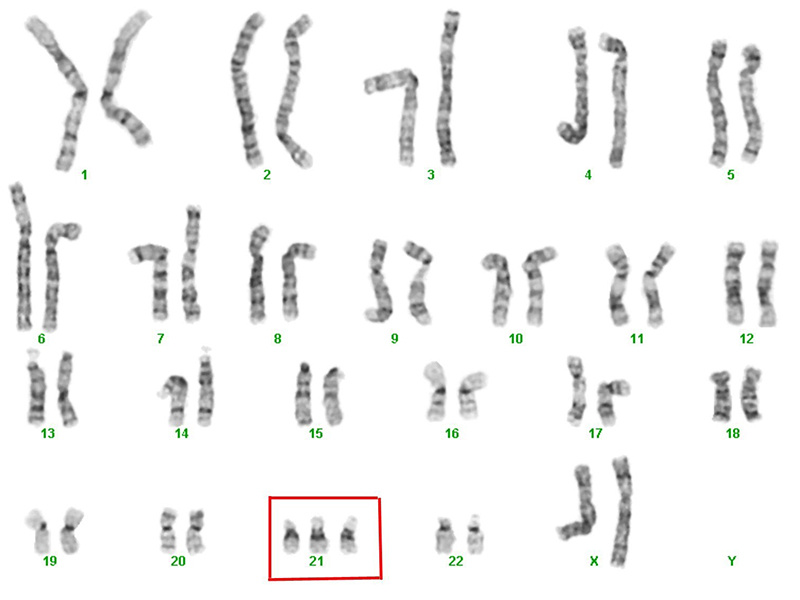 13號染色體異常危害大，易導(dǎo)致胎兒畸形