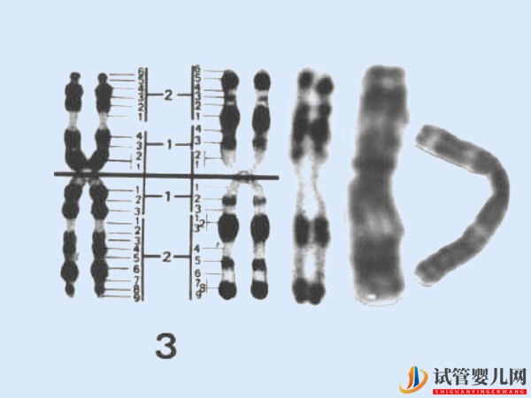 3號(hào)染色體異常會(huì)怎樣 - 基因微缺失、微重復(fù)相關(guān)病癥導(dǎo)航