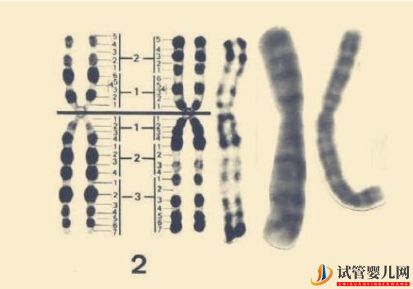 2號染色體異常的后果 - 三體、部分缺失胎兒癥狀表現(xiàn)整理