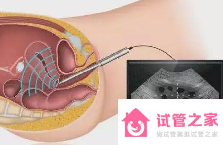 為什么高齡試管很難一次成功？這6點一定要提前了解