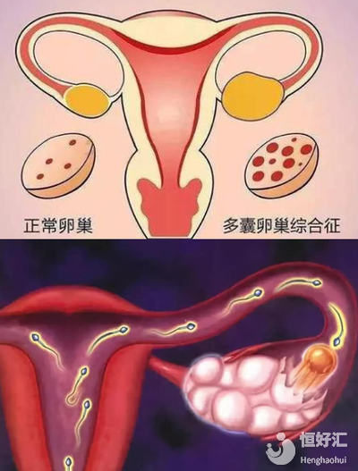 多囊*巢做試管究竟是好是壞？看完你就知道了