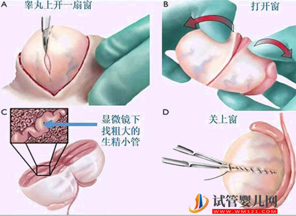 顯微取精技術(shù)和睪丸穿刺有差異，相關(guān)區(qū)別不只是費(fèi)用！